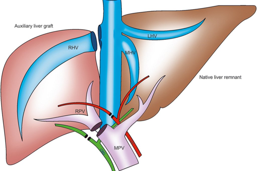dr-anandvijai-auxiliary-liver-transplant