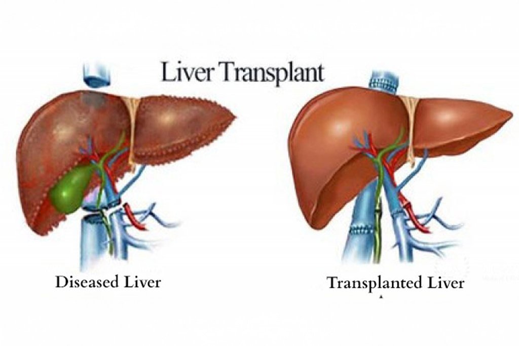 liver transplantation in coimbatore