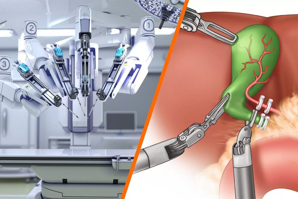 dr-anand-vijai-robotic-assisted-cholecystectomy