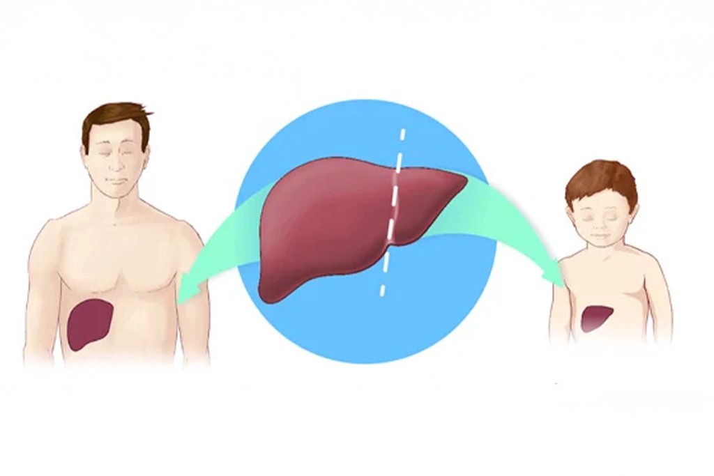 dr-anand-vijai-split-liver-transplant