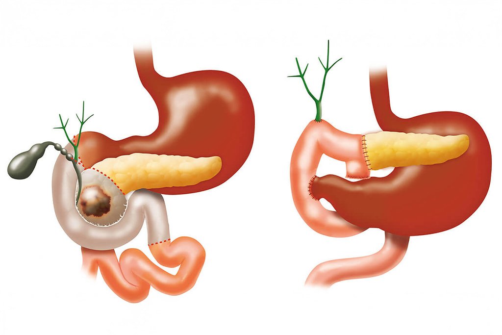 dr-anand-vijai-whipple-procedure